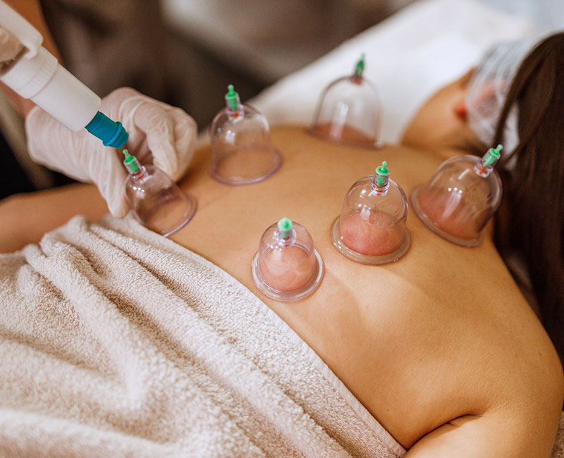 Traditional cupping therapy