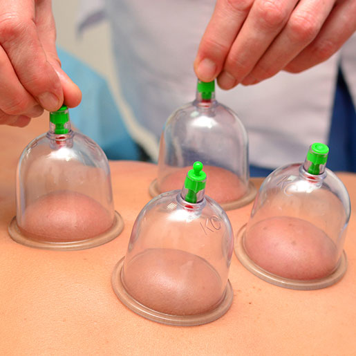 Cupping treatment session